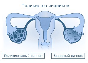Синдром поликистозных яичников (СПКЯ)