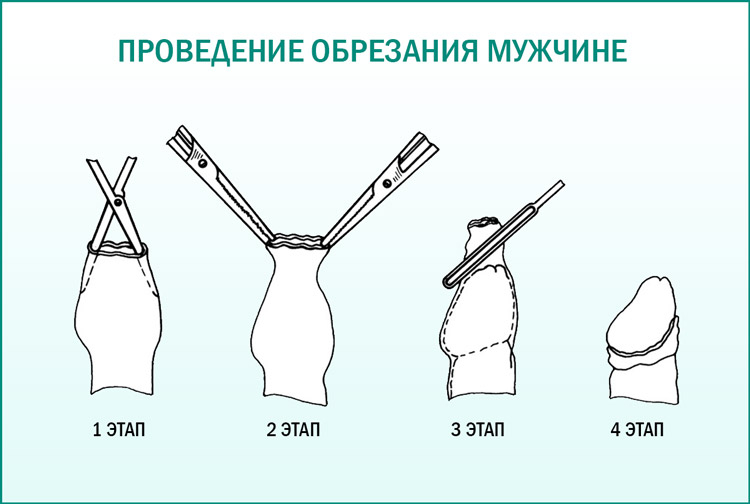 Сделать обрезание крайней плоти у мужчин в Москве, цена 11500 руб