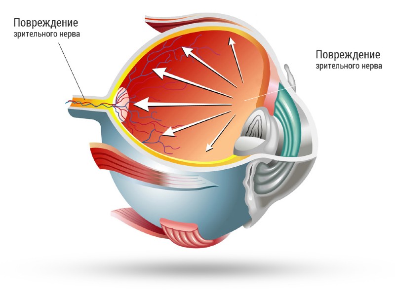Глаукома - лечение и симптомы
