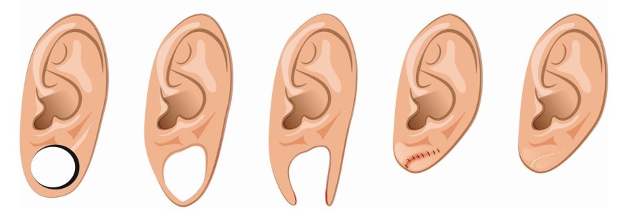 коррекция мочки уха